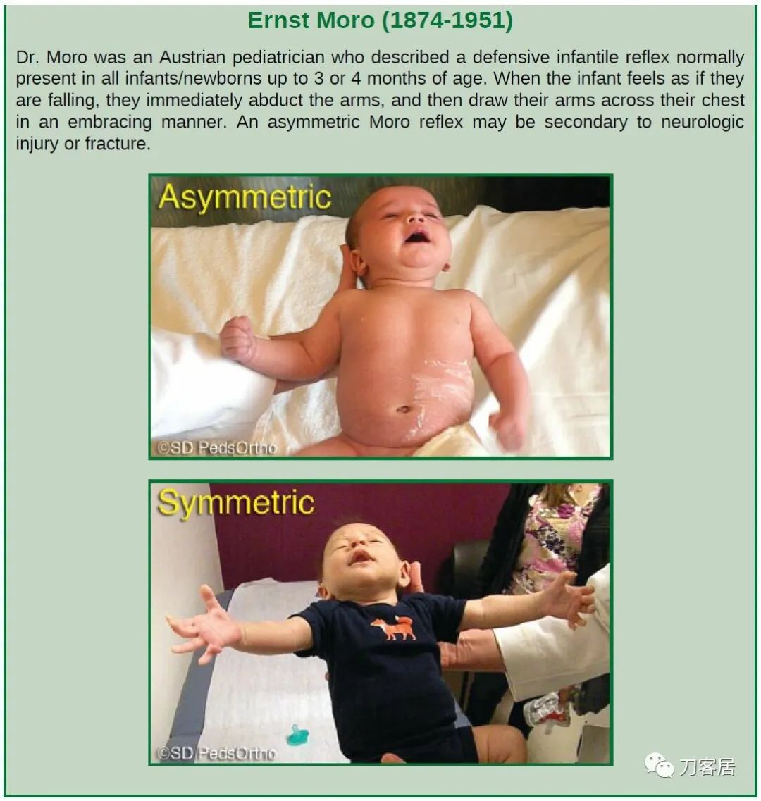 儿童锁骨骨折保守治疗的弊端,锁骨粉碎骨折错位不处理会愈合吗