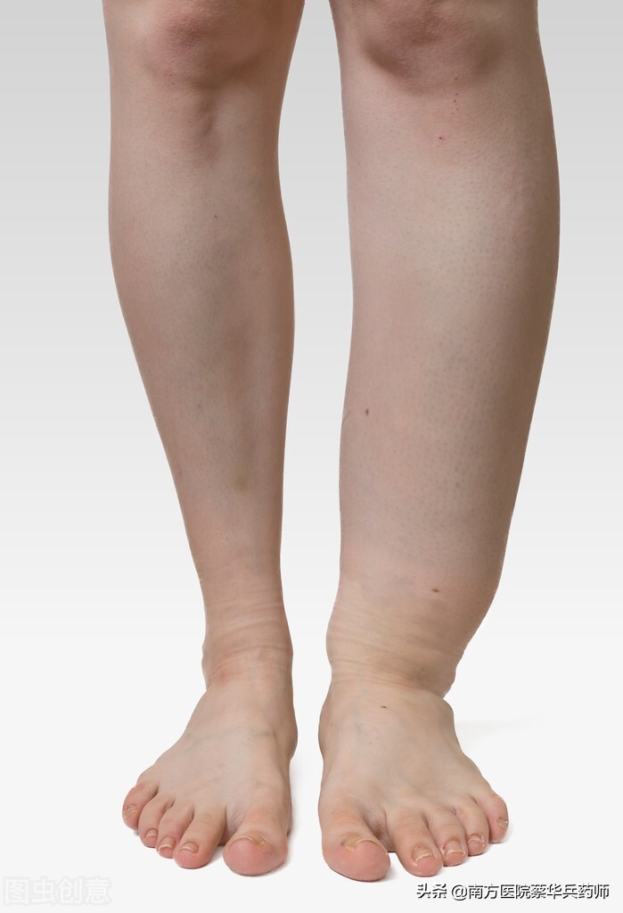 中医彻底根治水肿的方法,水肿的中医西医治疗方法对比