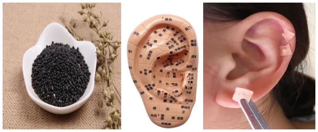 济南哪里可以耳穴压豆,耳穴压豆穴位的疗效