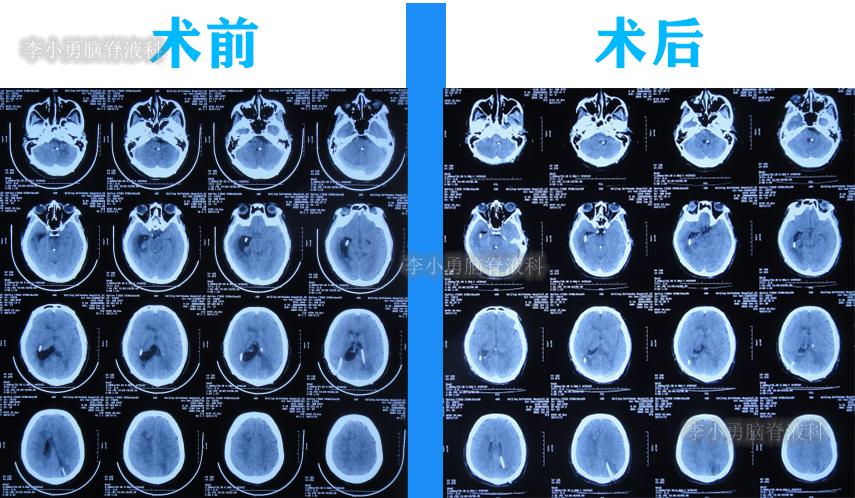 脑积水三脑室造瘘多久能恢复,脑囊虫手术后脑积水