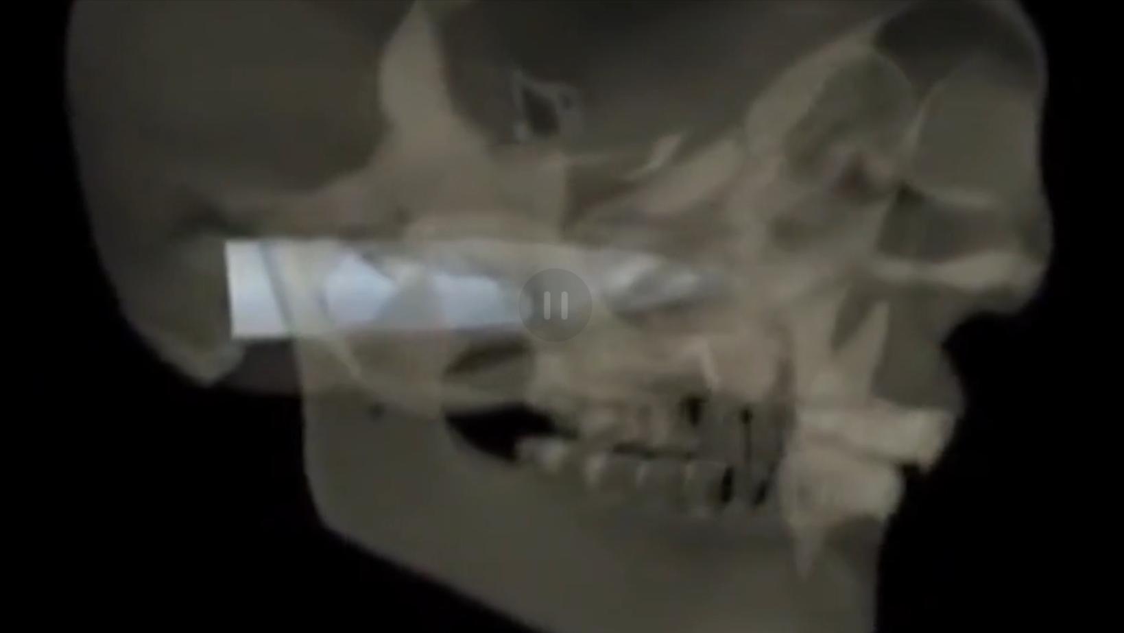 云南男子口臭手术后现在怎么样了,云南男子口臭查出了大毛病