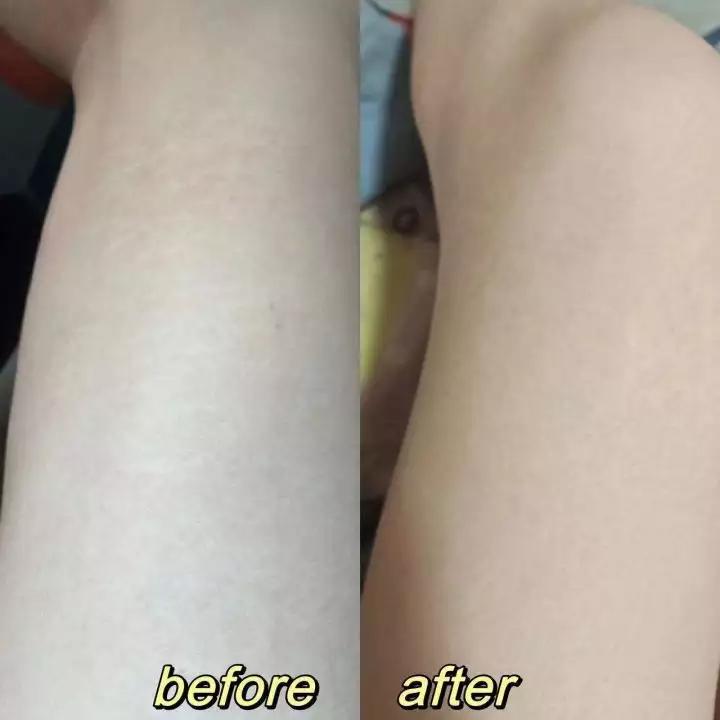 淡肥胖纹最简单有效的方法,用什么方法让肥胖纹彻底消失