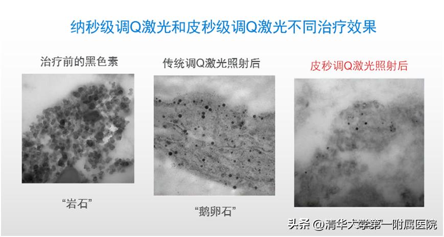 来深度了解皮秒激光美白祛斑效果,一起美起来
