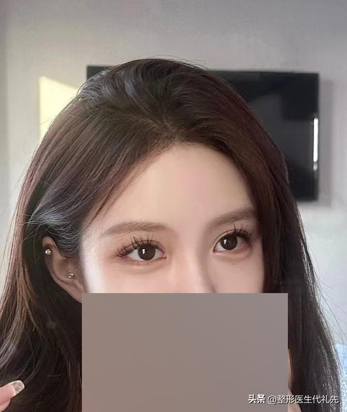 眼袋与卧蚕与泪沟的区别,做卧蚕跟眼袋的区别