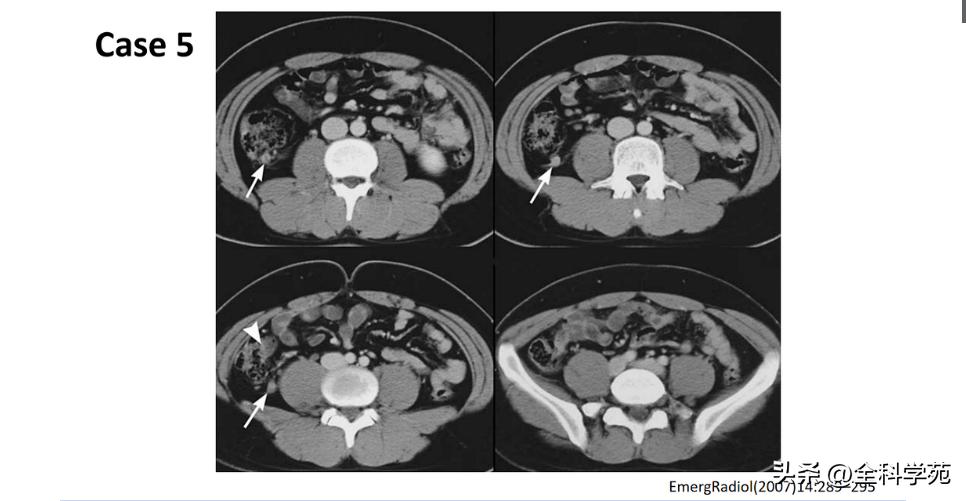 阑尾炎的讲解,关于阑尾炎的讨论总结