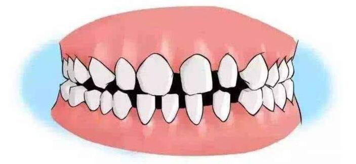 牙缝大牙齿怎么补,牙齿稀疏牙缝大有什么危害吗