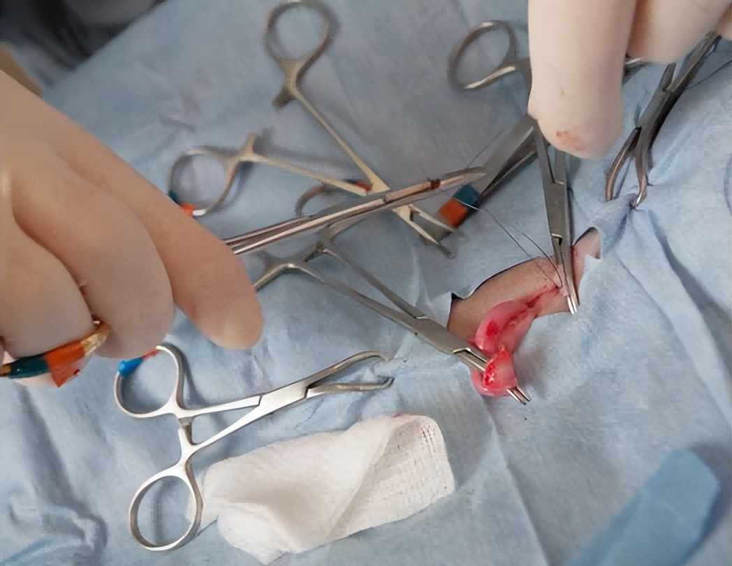 为什么不建议女人去做某些手术，医生用一个个血淋淋的例子告诉你