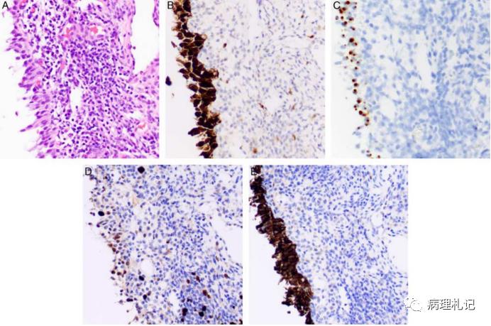宫颈病理免疫组化p16是什么意思,p16阳性低度上皮病变严重吗