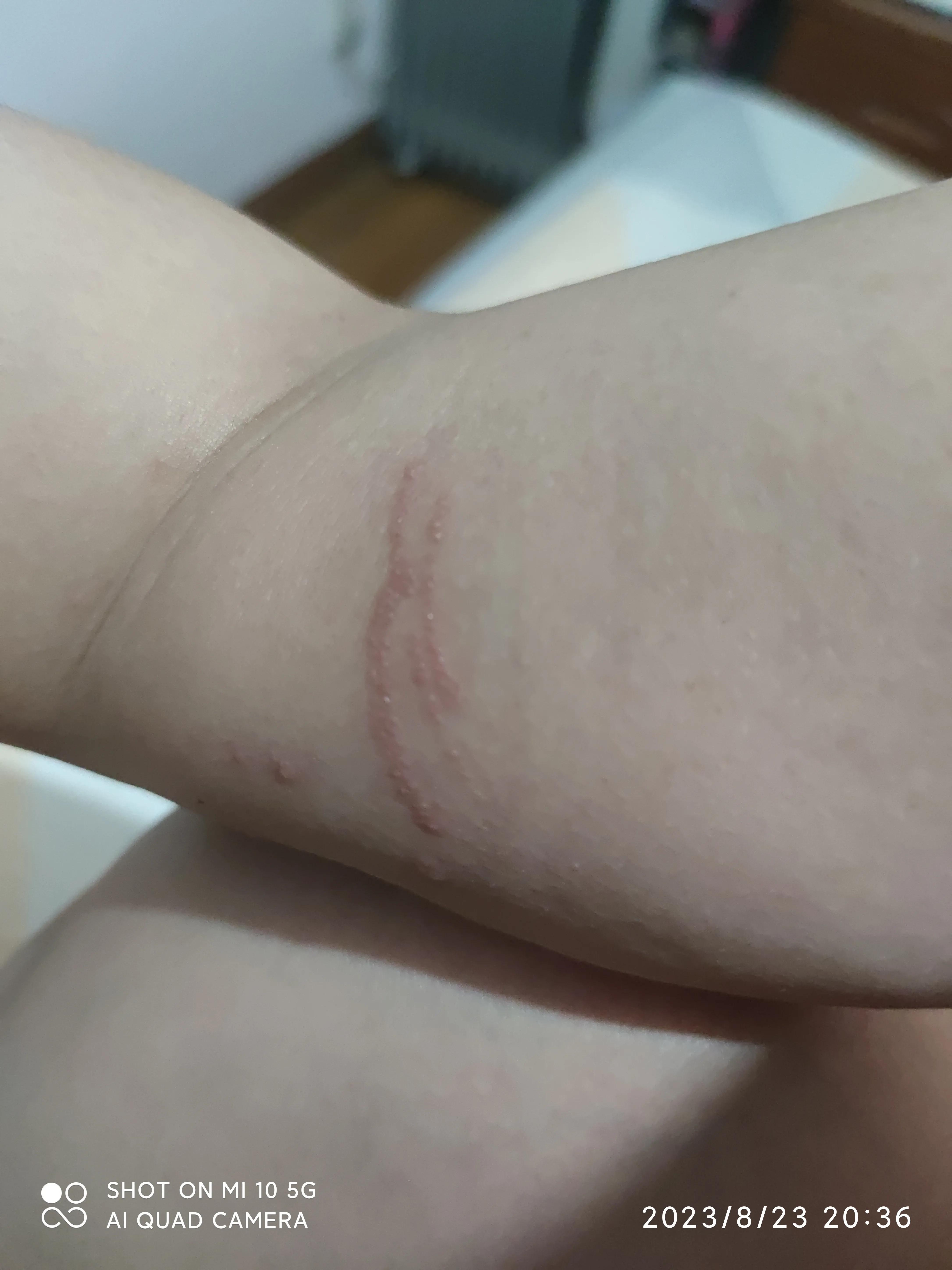 中医说疱疹怎么得的,中医让人糊里糊涂活着