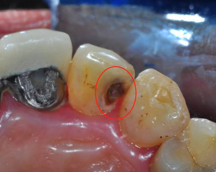 补牙后半年了牙疼是什么原因,补牙后牙疼怎么确定是不是没补好