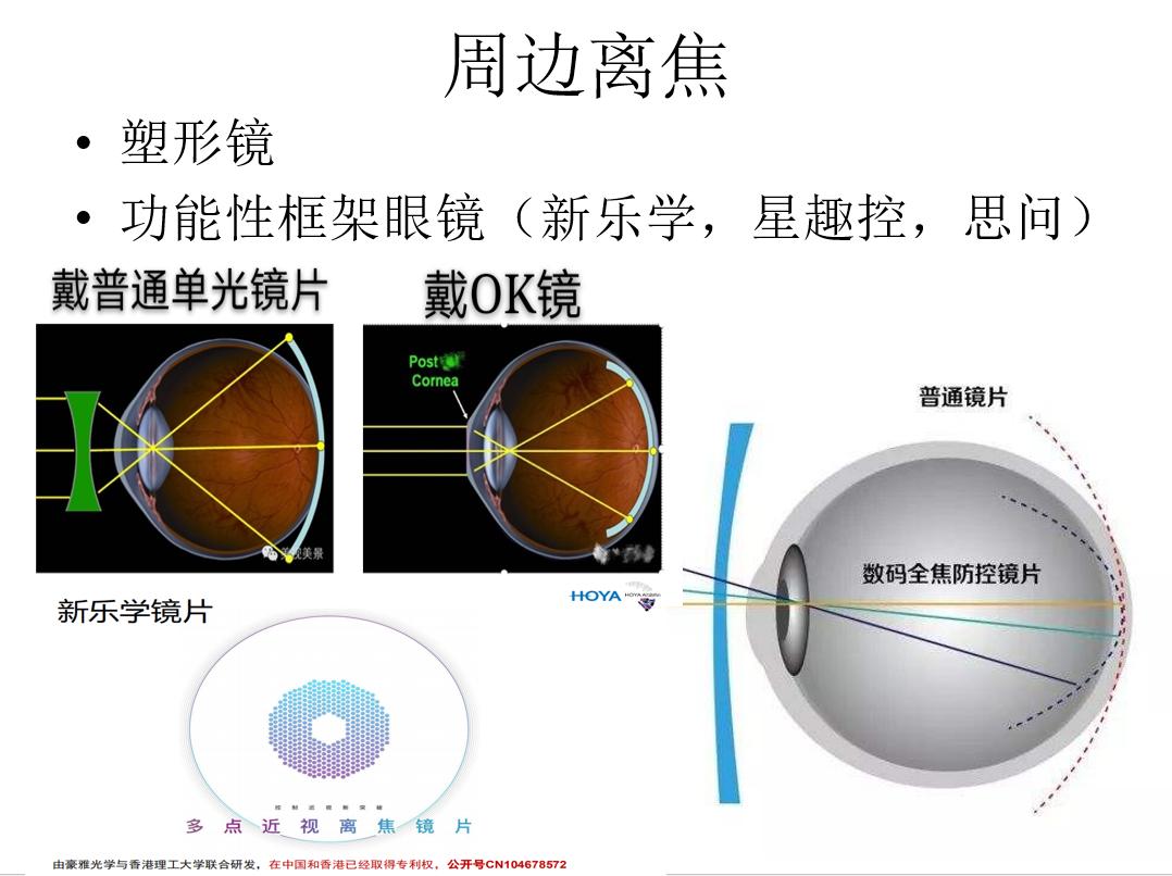 孩子近视最好的解决方案,孩子近视200多度到底怎么治疗好