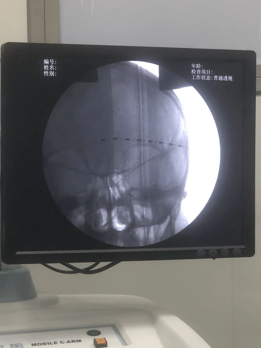 神经电刺激植入术为顽固性头面部带状疱疹后遗神经痛患者解忧