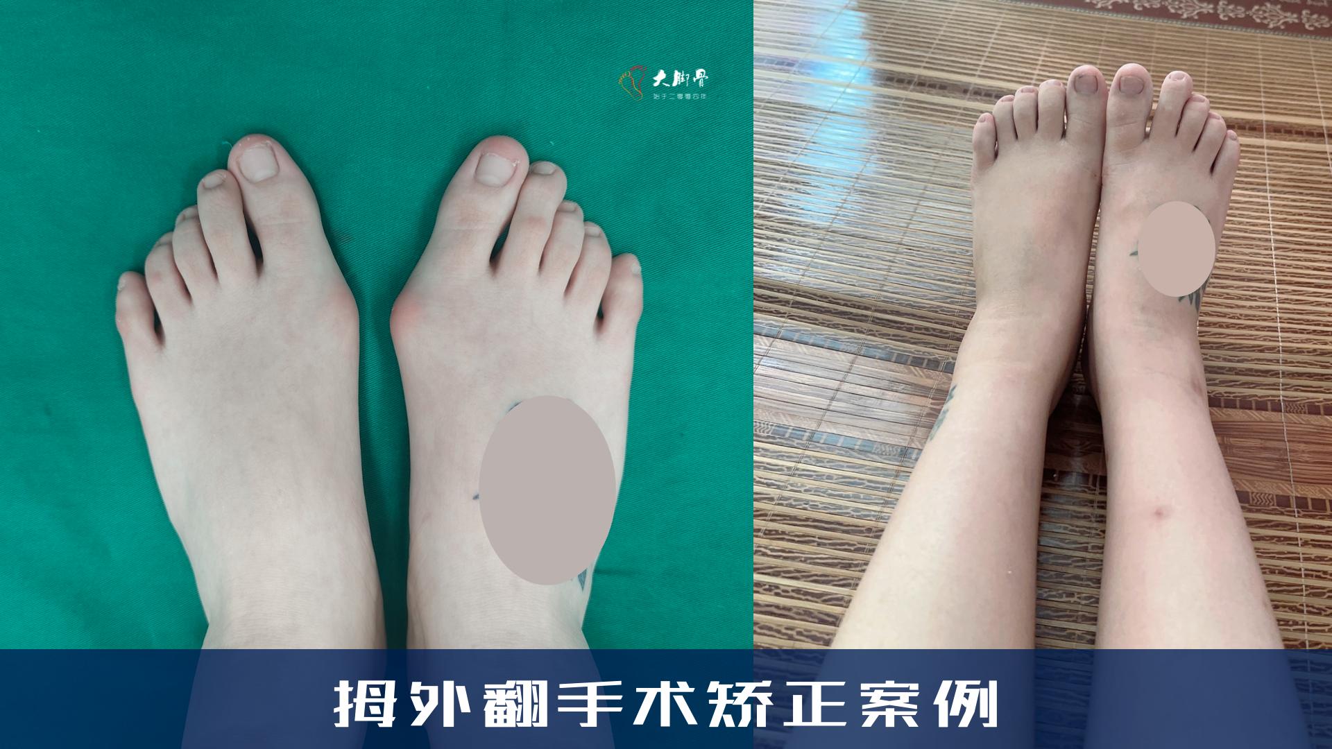 矫正拇外翻一般多少钱一次手术,小女孩一只脚拇外翻怎么矫正最快