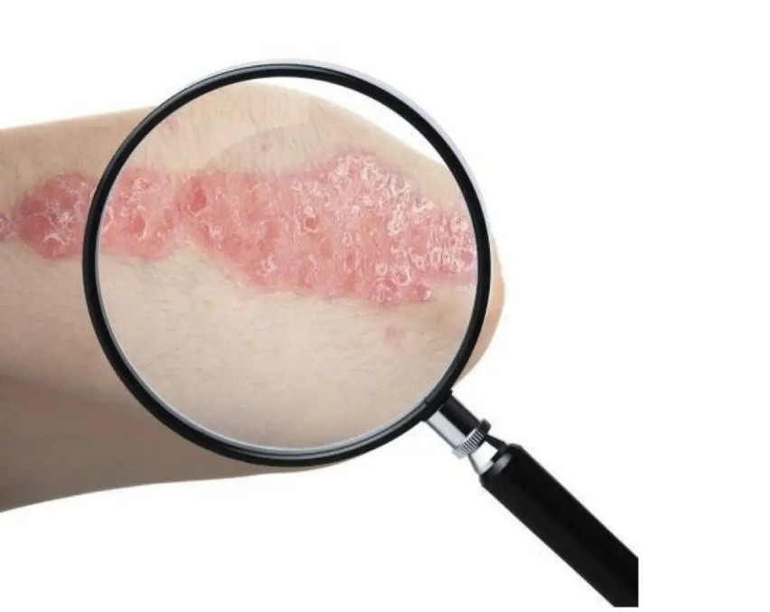 湿疹瘙痒难忍中医教您防治好方法,中医治疗湿疹是让湿疹发出来吗