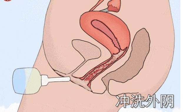 宫颈癌治疗期间，“阴道冲洗”必不可少，且有讲究