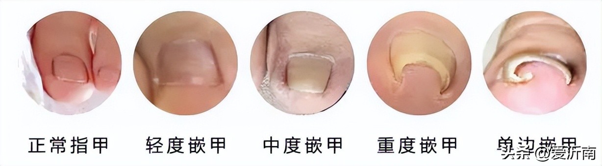 脚趾甲沟炎肿了涂什么药膏,小孩脚趾甲沟炎又红又肿怎样治疗