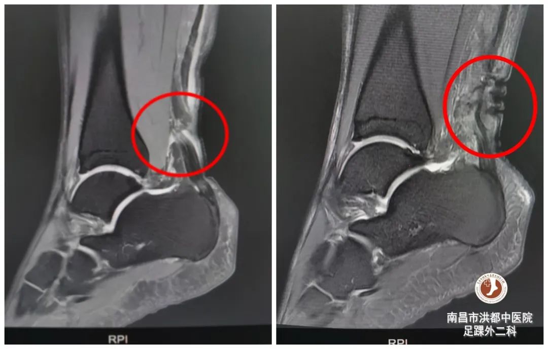 足球运动员韧带断裂修复费用,足球运动员断腿手术