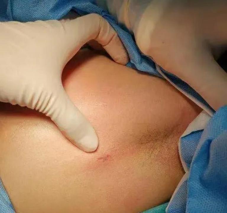 手心出汗是因为着急吗？不，手心总大量出汗是手汗症，要治疗