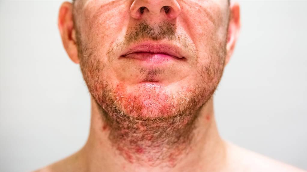 维生素b6缺乏了会怎么样,维生素B6缺乏会导致什么