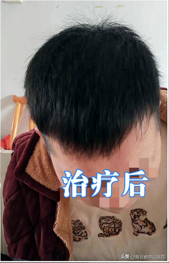 【中山医“声”】一根、两根、三四根，小伙“秃”然慌了
