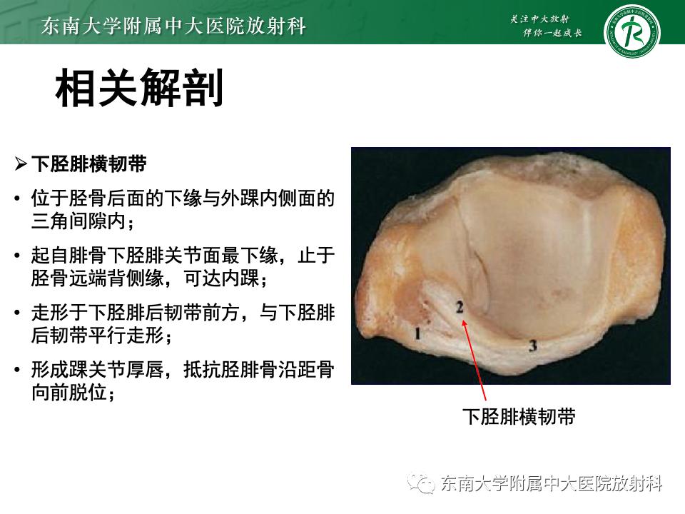 左腓骨下段骨折伴下胫腓联合分离,好文分享深度揭秘