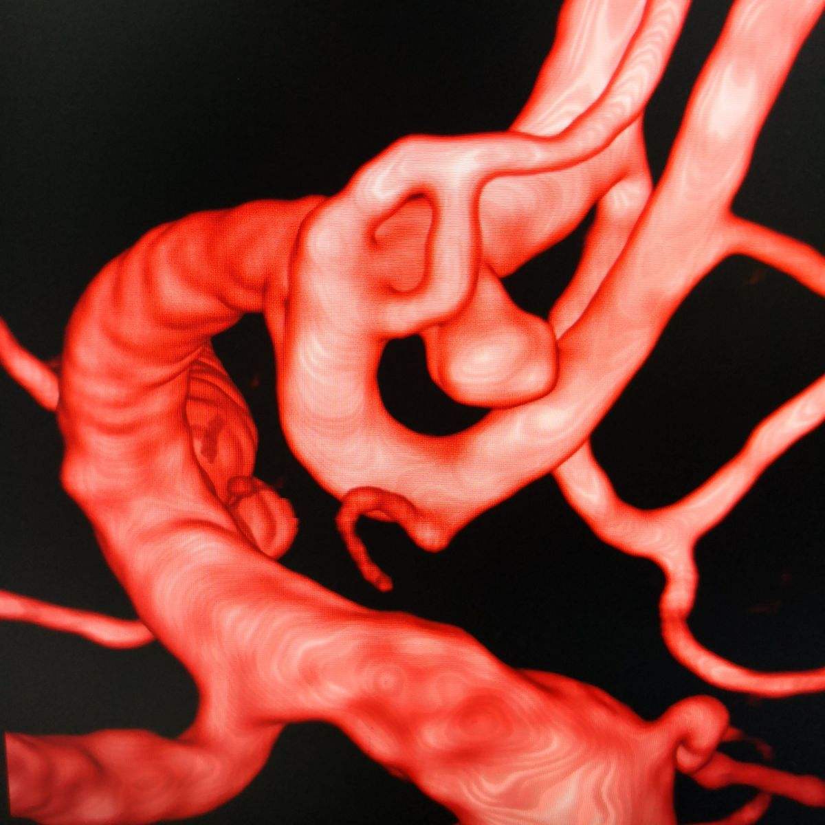 动脉瘤蛛网膜下腔出血术后并发症,动脉瘤导致蛛网膜下腔出血严重吗