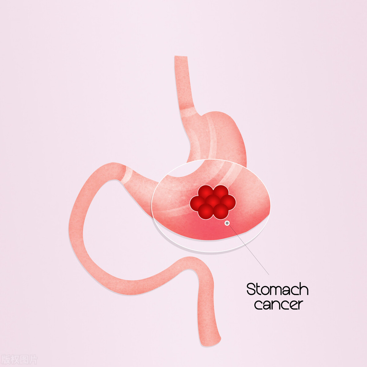 胃癌高危指标图解,降低胃癌发病率的重要手段