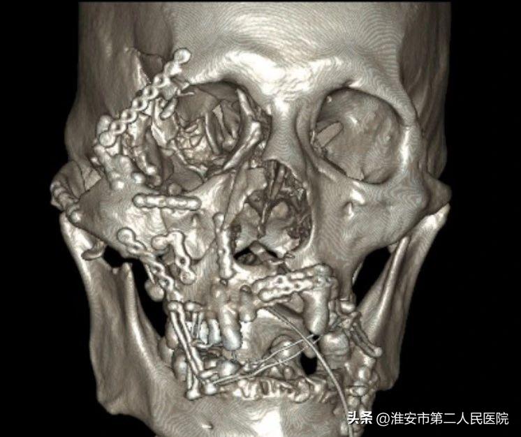 骑车摔倒擦伤皮肤的照片,骑车摔倒照片皮外伤