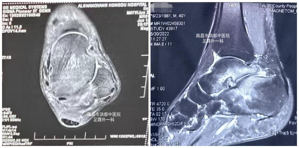 脚踝扭伤腓骨肌腱脱位的症状,踝关节外侧韧带损伤发病原因