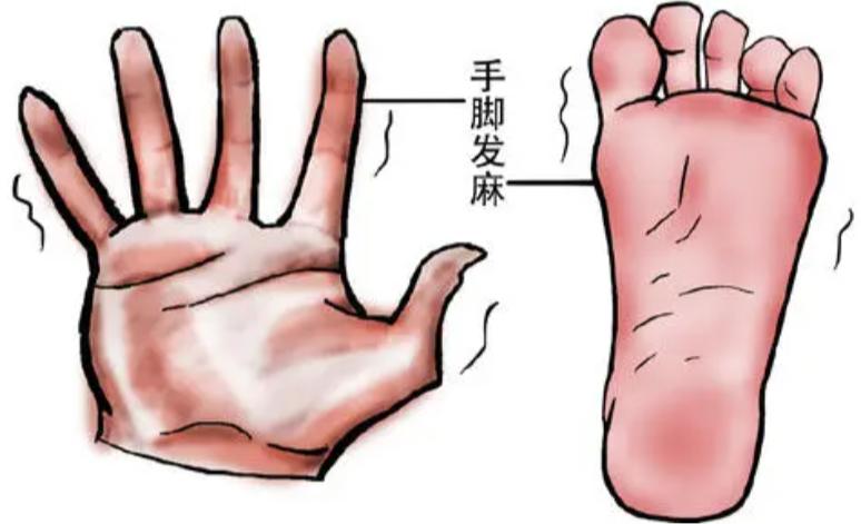 治化疗后手脚麻木的偏方,化疗后手脚麻用什么中药洗有效