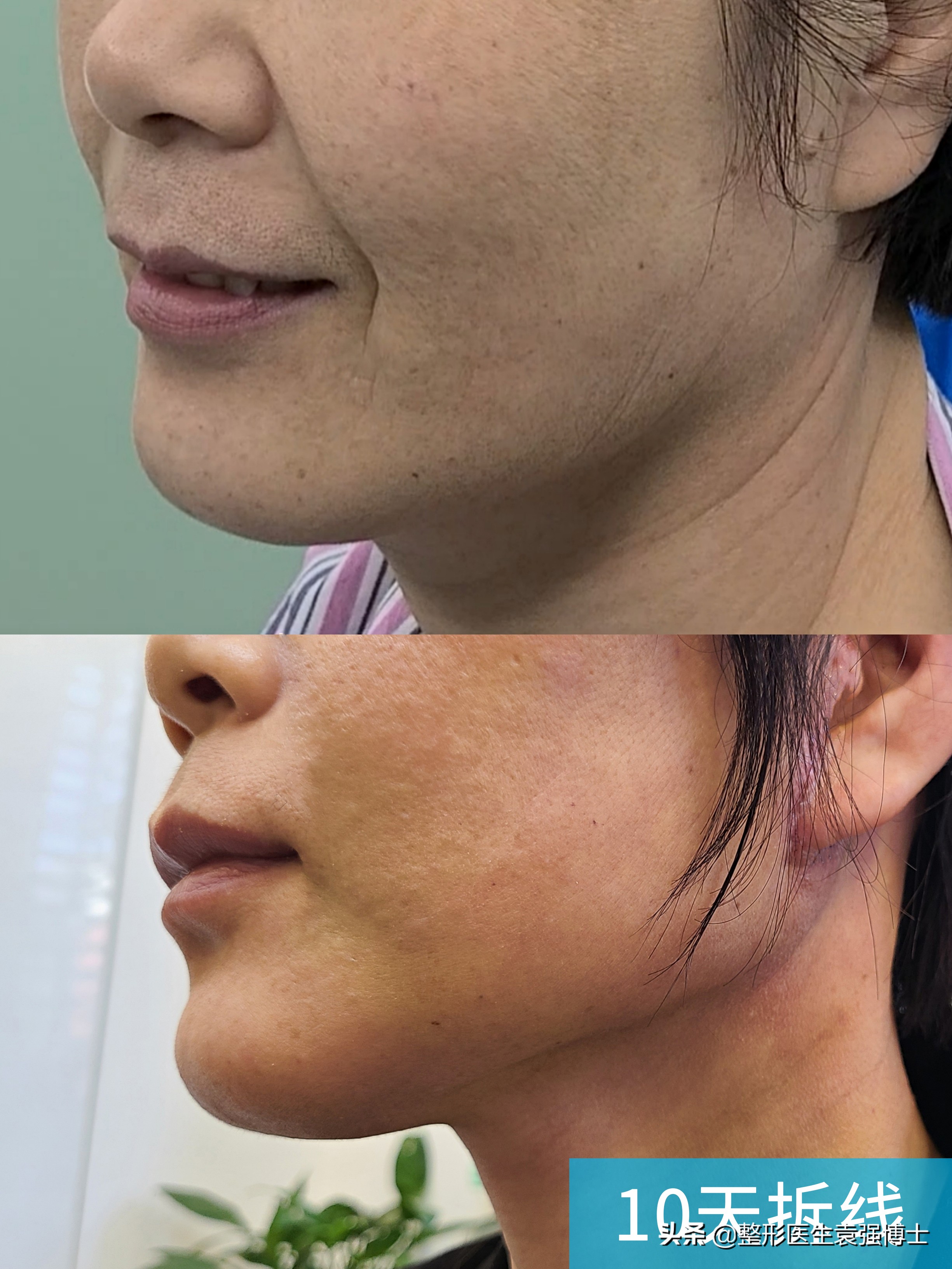 腹部拉皮亲身经历,拉皮去皱亲身经历做小拉皮失败率