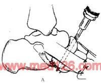 扁平足发病机制,扁平足诊断标准示意图