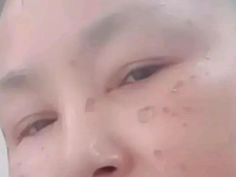 药水点斑有没有点好的呢,药水点斑的亲身经历