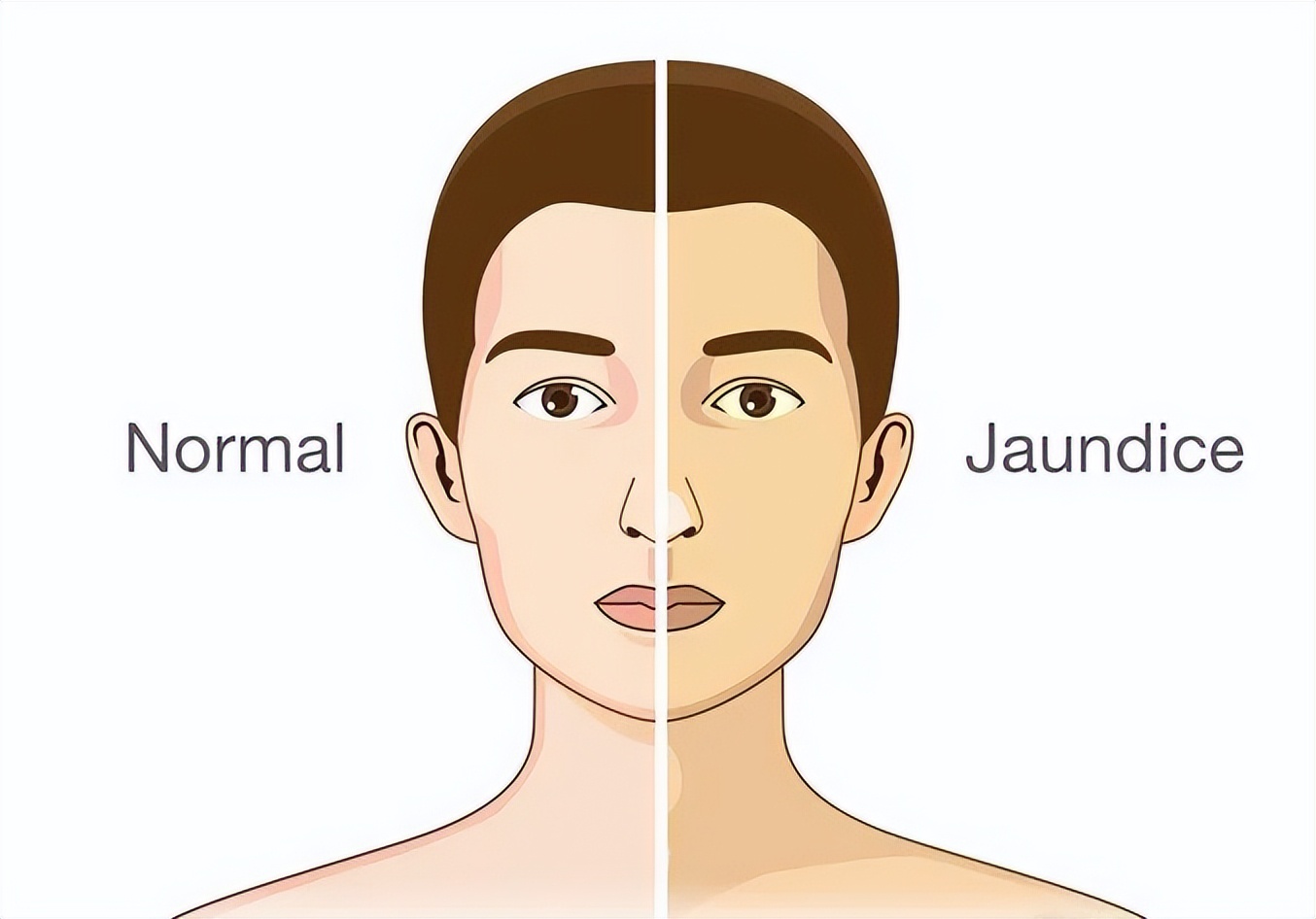 胰腺癌厌食症发生的机理,胰腺癌恶心呕吐原理