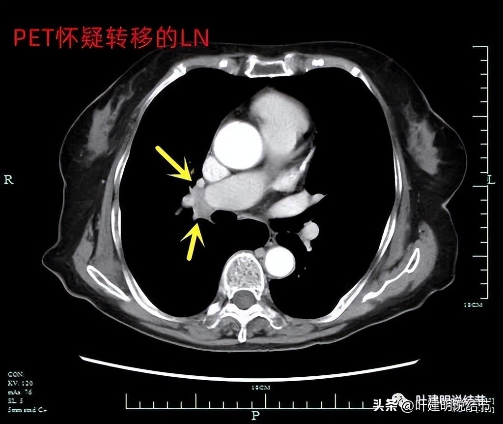 79岁肺癌早期手术风险,75岁早期浸润性肺癌还要治疗吗