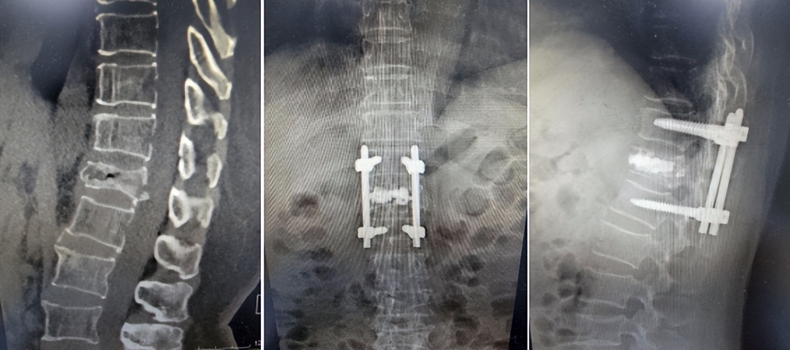 鑴婃煴渚у集妞嶉铻嶅悎鎵嬫湳,鑴婃煴渚у集鑵版铻嶅悎鎵嬫湳