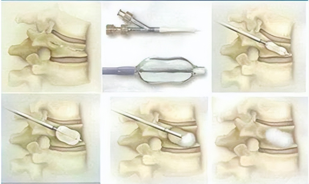 胸腰椎压缩性骨折特色治疗方法,老年人胸腰椎骨折怎么治疗
