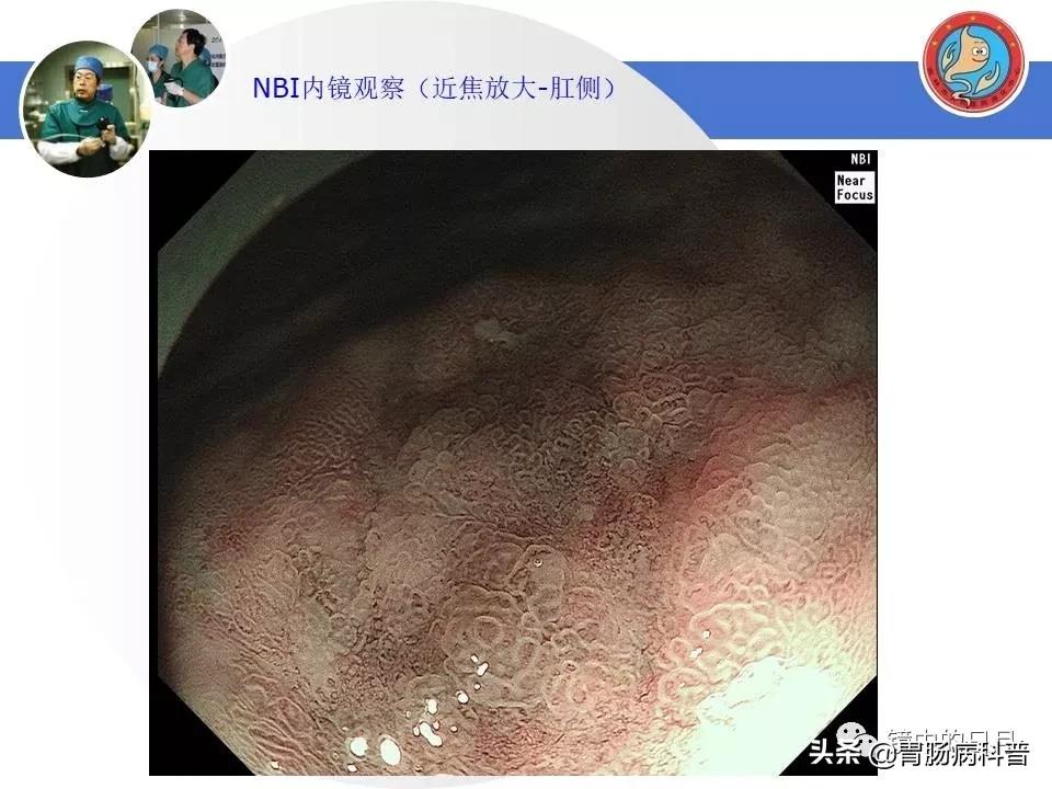 胃癌可以做内镜手术吗,早期胃癌内镜手术后追加外科手术