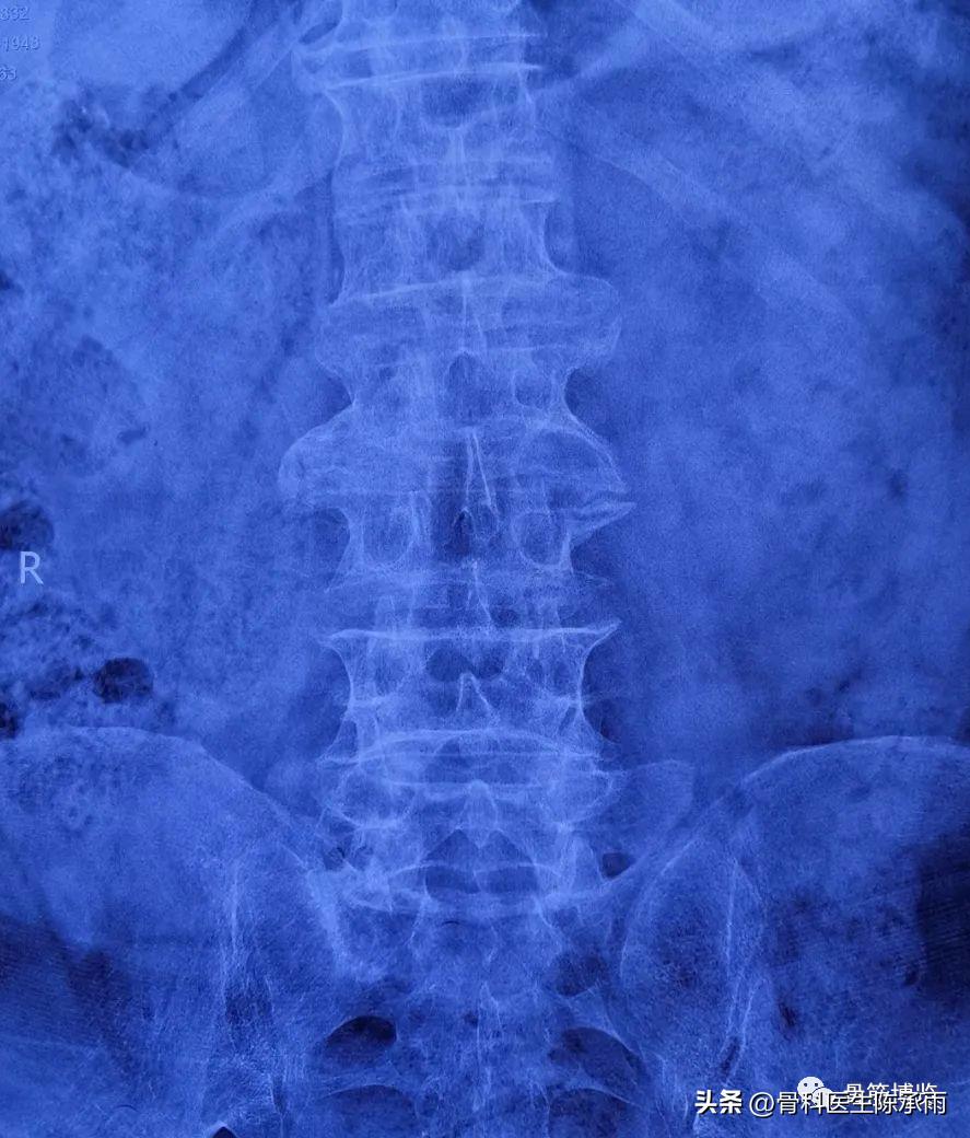 腰椎滑脱椎管狭窄手术后遗症,腰椎间盘突出椎管狭窄的手术