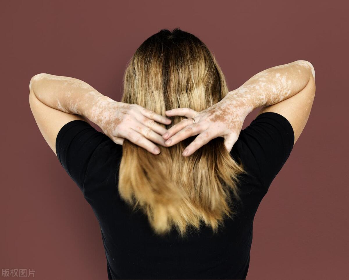 白癜风的面积大小会影响疾病的治疗吗？