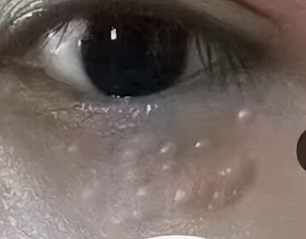 眼睛周围总感觉有飞虫是怎么回事,眼睛周围有飞虫的感觉