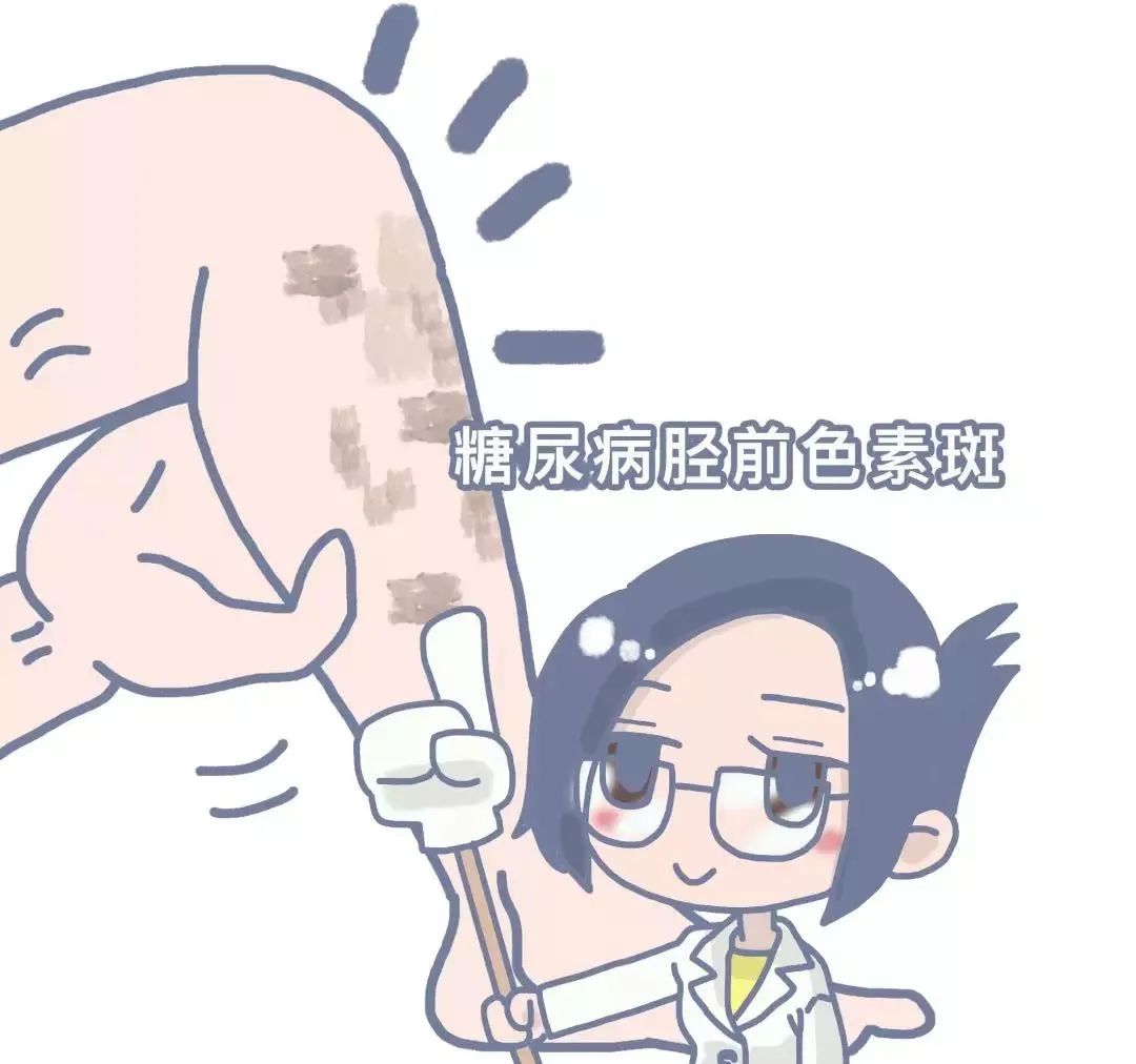 腿上出现斑点是糖尿病的前兆吗,糖尿病人腿上出现糖斑图片