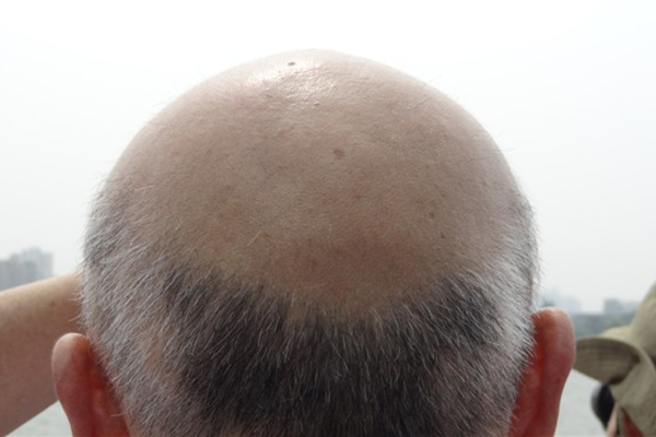 成年男性缺乏雄性激素,男性缺乏雄性激素有什么症状