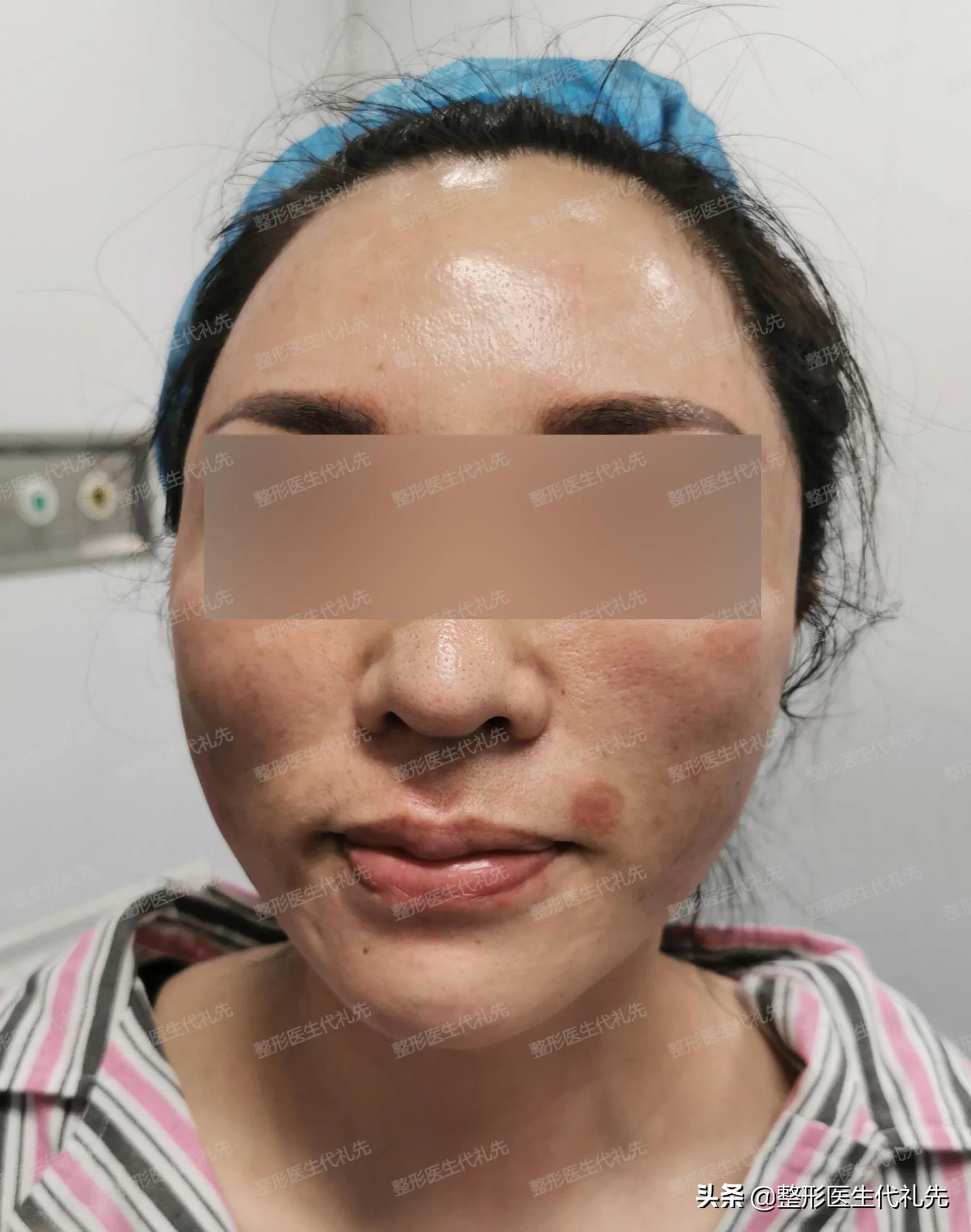 法令纹面部提升手术以后有疤痕吗,法令纹做面部提拉手术有效果吗