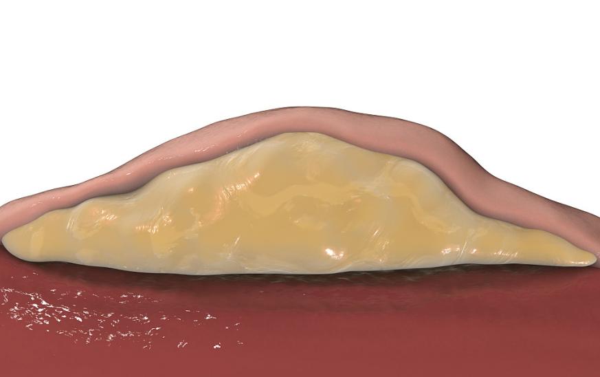 肉瘤是什么癌症,肉瘤和癌的区别是什么