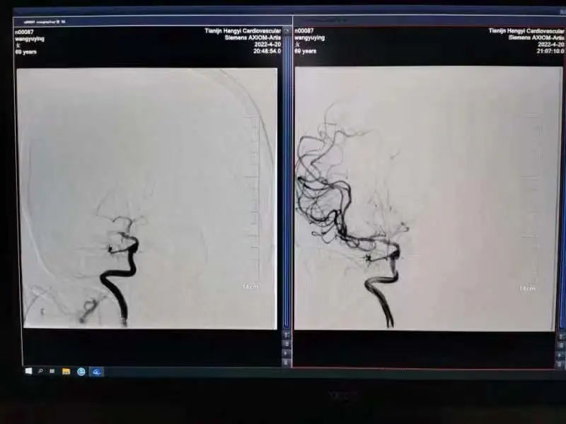 医生紧急抢救心梗脑梗视频,紧急救治脑梗病人