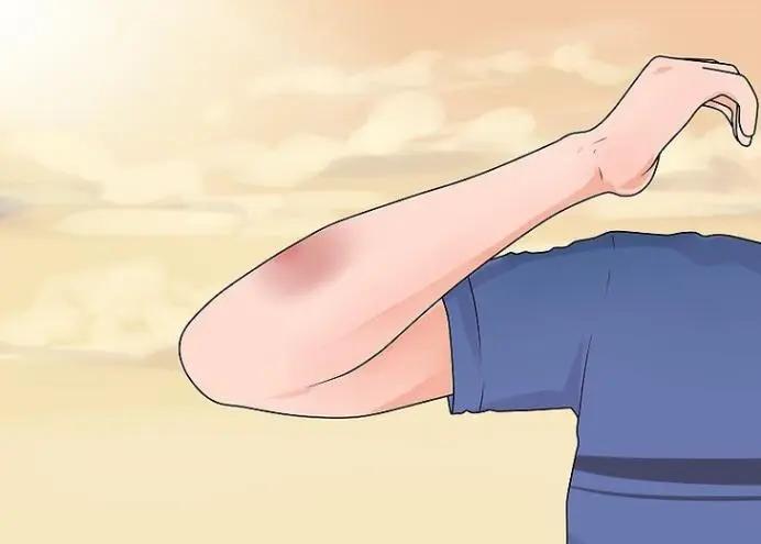 淤青用冷敷还是热敷最有效果,淤青用冷敷还是热敷好