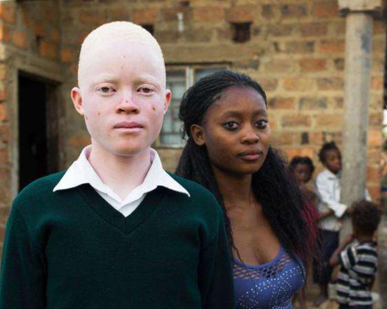 非洲最特殊的人群：血液堪比黄金，遗骸卖上百万，却无法健康成长