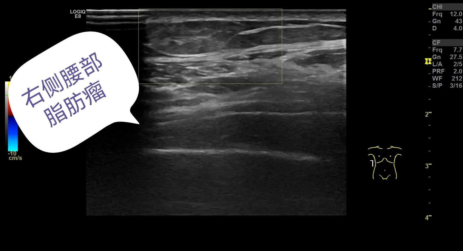 身体腰背部腹部两侧有小硬疙瘩,大腿和腰部起了大片的疙瘩