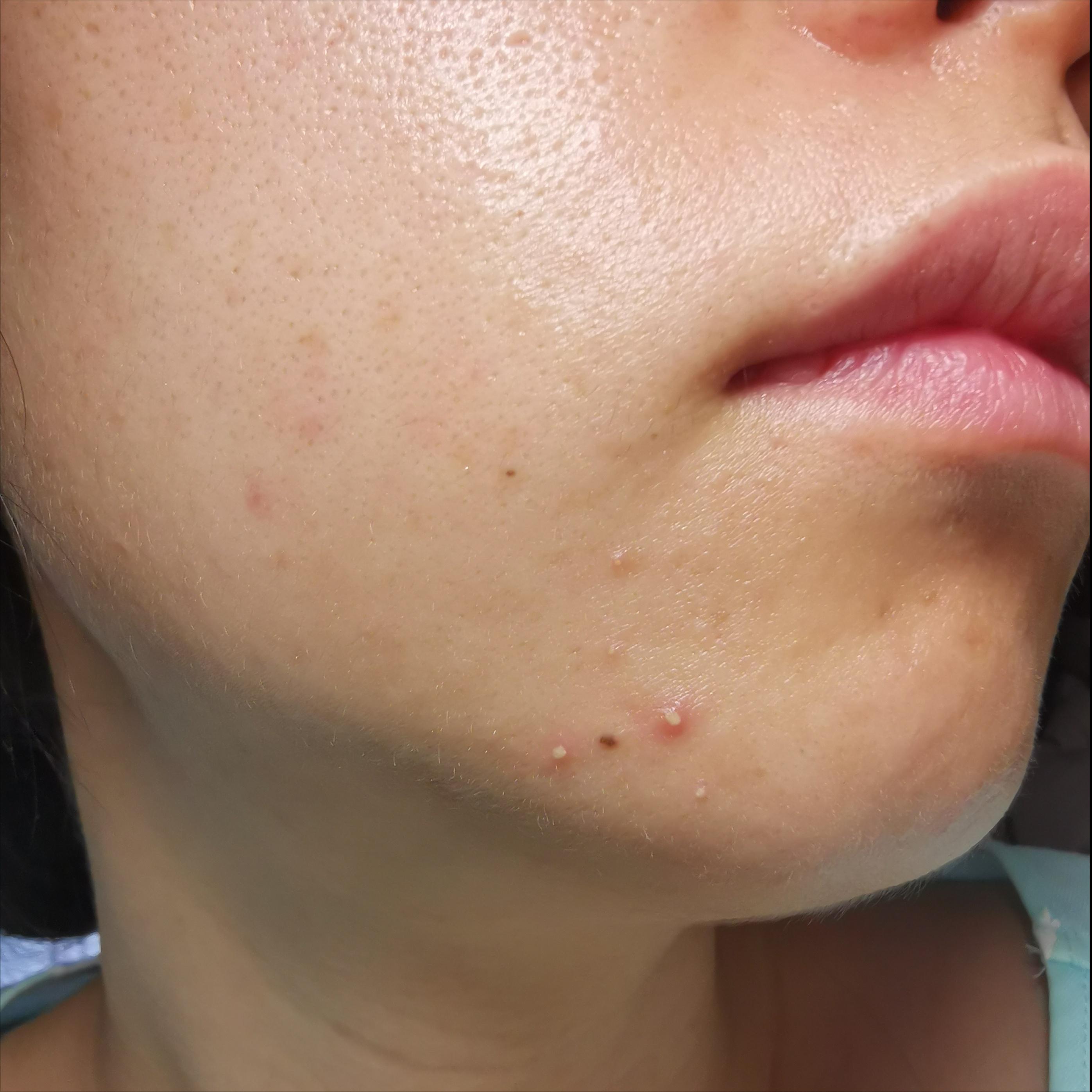 真人测评15天祛痘,真实测评一个月效果